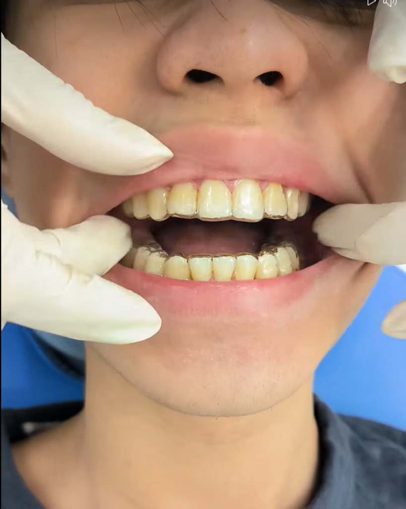 niềng răng thành công