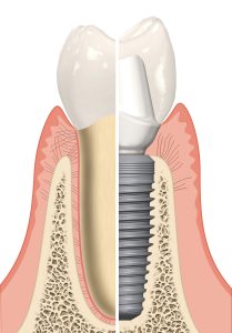 dịch vụ implant