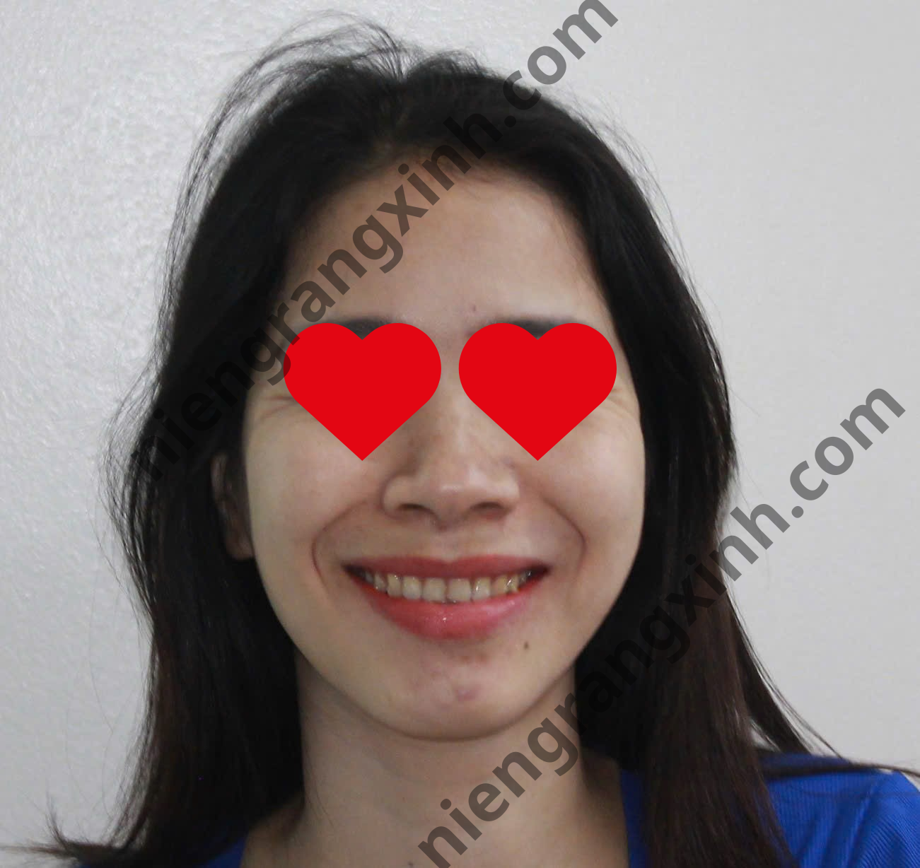Sau 3 tháng niềng Invisalign - Kiều