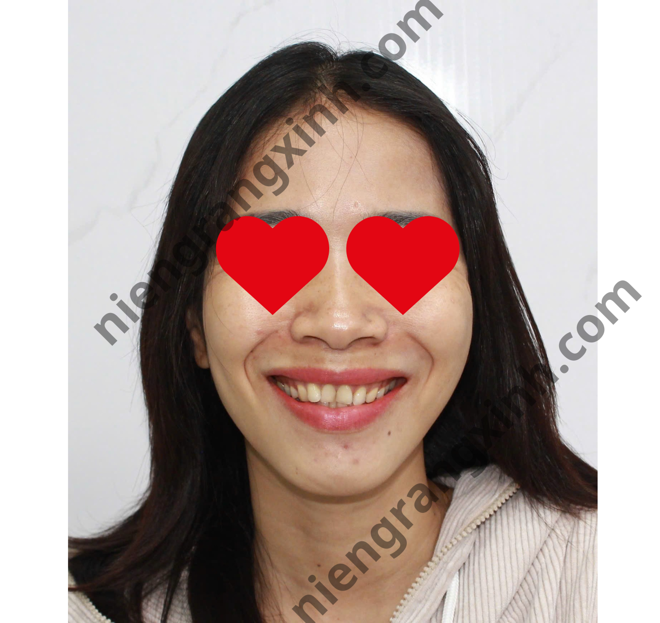 Trước khi niềng Invisalign - Kiều